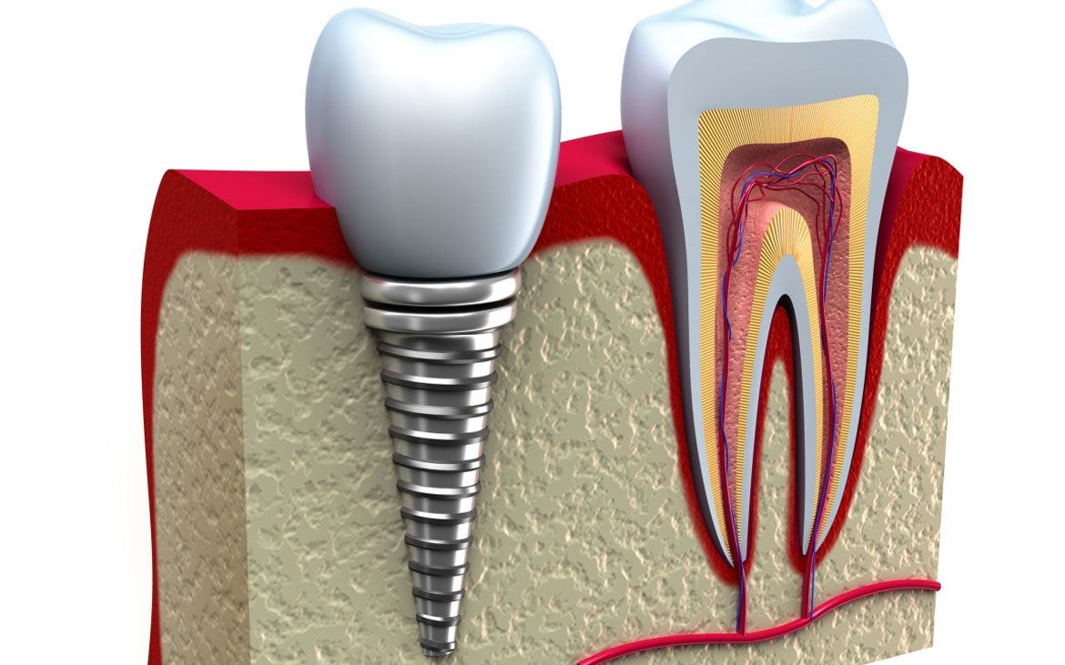 Dental Implants